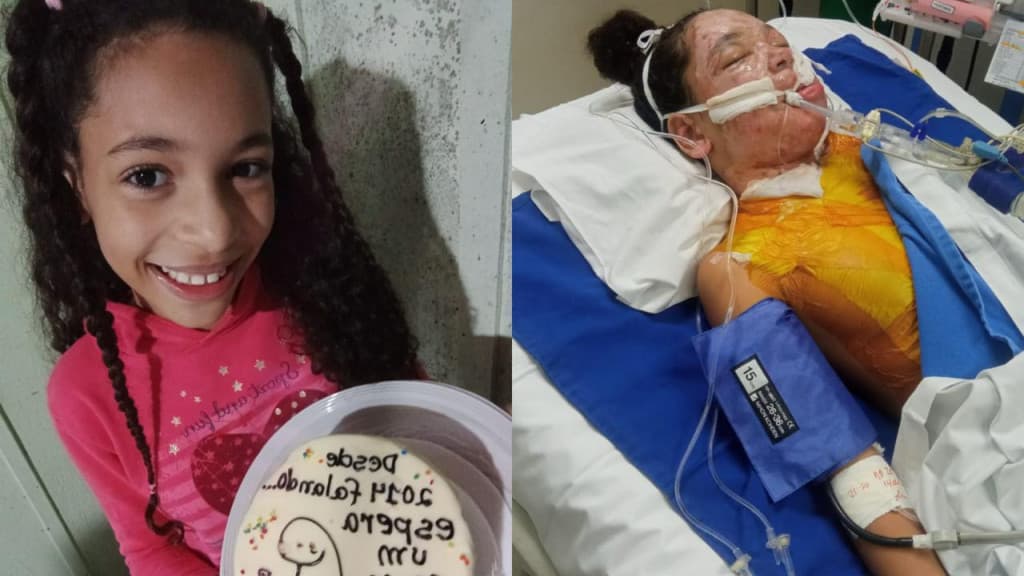 “Milagre”: acidente doméstico quase mata menina de 10 anos