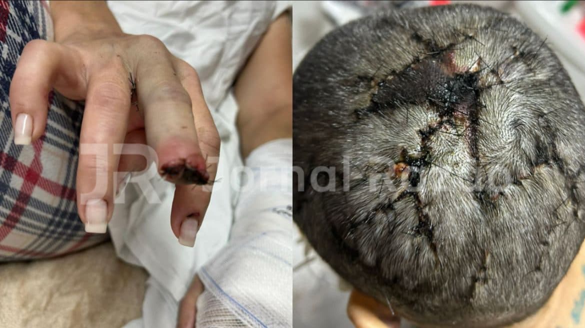Mulher espancada pelo enteado em SC teve dedo amputado e levou mais de 300 pontos na cabeça