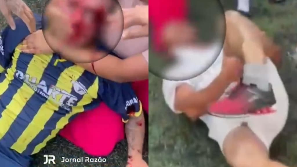 Pai é espancado e tem perna quebrada ao defender filho de agressão em partida de futebol