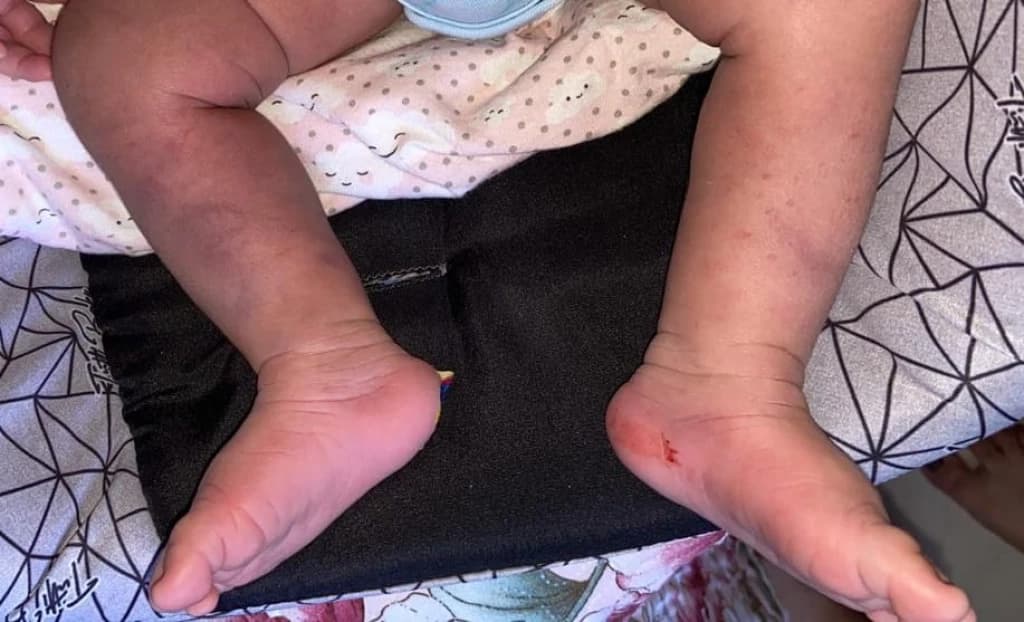 Acusado de machucar bebê em teste do pézinho em Tijucas é afastado