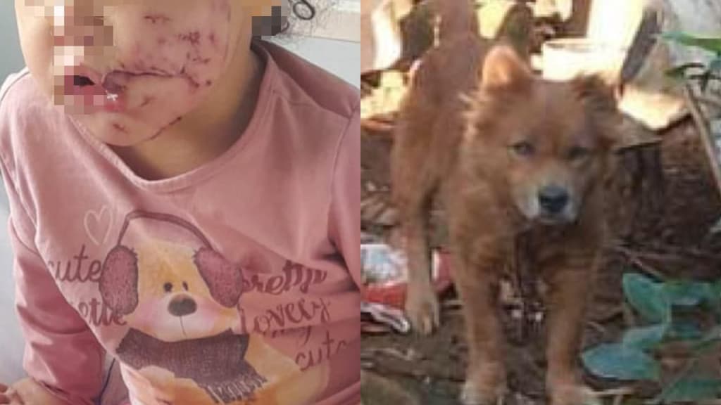 Criança vai passar por cirurgia após ataque de cachorro em SC