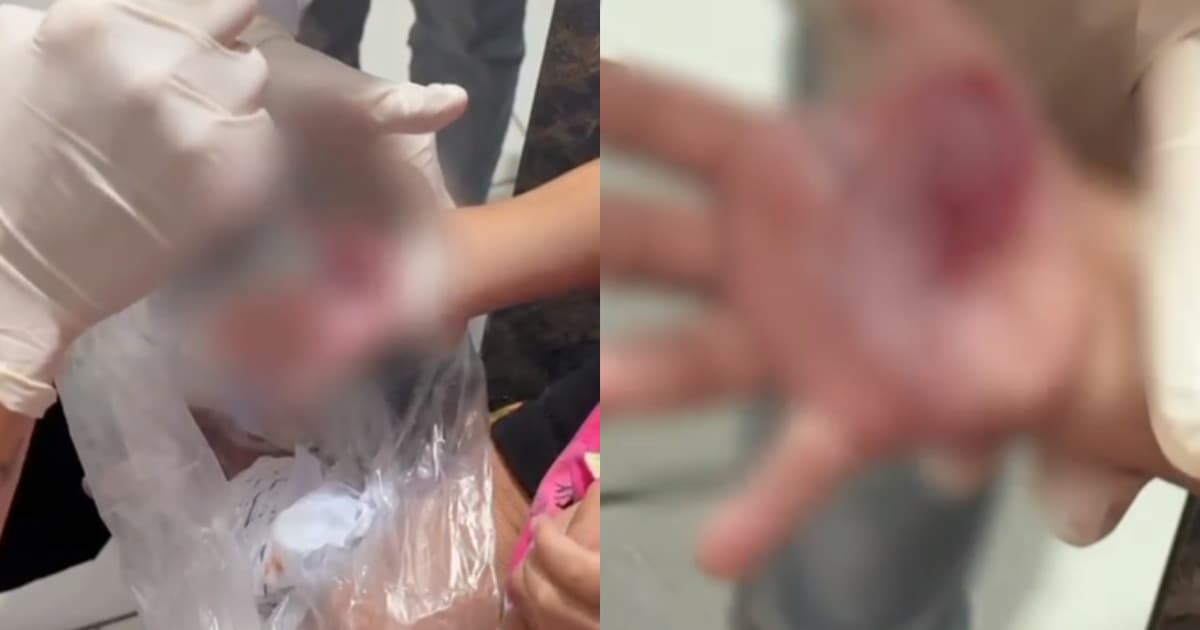 “Derreteu a mão”: revelado o motivo do castigo chocante de madrasta contra criança em Itajaí